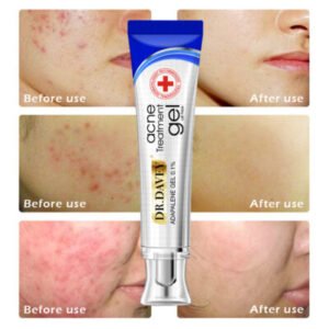 dr. davey acne treatment gel oil free cream